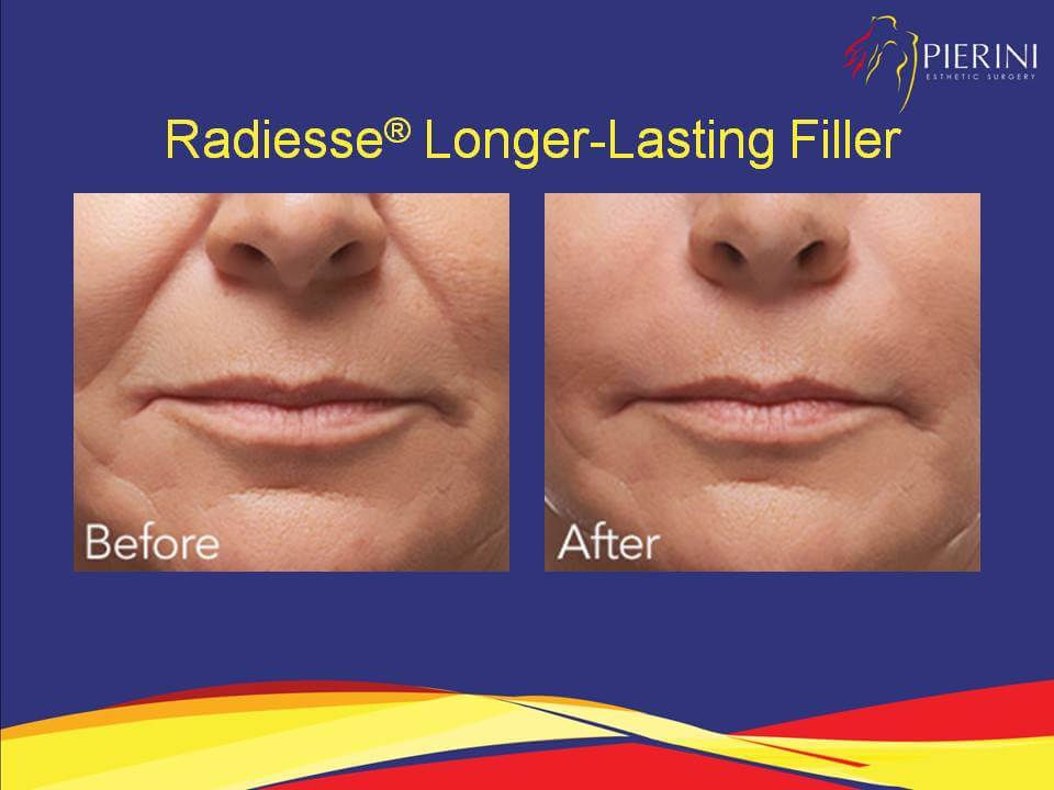 Radiesse® Before & After
