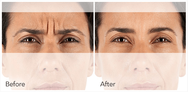 Before & After Xeomin®