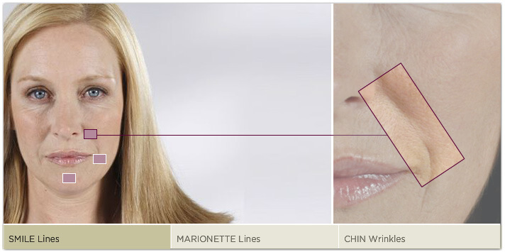 Where is Sculptra® used?