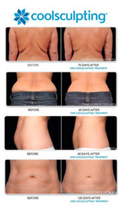 coolsculpting-page-b-a