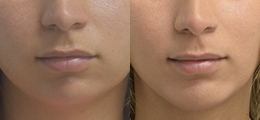 Buccal Fat Pad Removal Before and After - Pierini A Solution For Beauty
