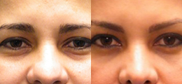 Brow Lift Before and After - Pierini A Solution For Beauty