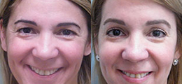 Chemical Peel Before and After - Pierini A Solution For Beauty