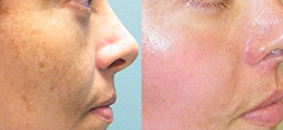 Chemical Peel Before and After - Pierini A Solution For Beauty
