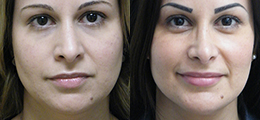 Double Chin Surgery Before and After - Pierini A Solution For Beauty