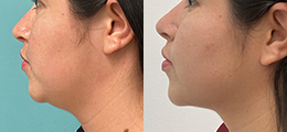 Double Chin Surgery (Submental Liposuction) Gallery