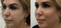 Dermal Fillers Before and After - Pierini A Solution For Beauty
