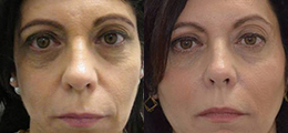 Dermal Fillers Before and After - Pierini A Solution For Beauty