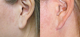 Earlobe Repair Before and After - Pierini A Solution For Beauty