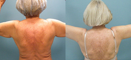 Arm Lift Before and After - Pierini A Solution For Beauty