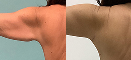 Arm Lift Before and After - Pierini A Solution For Beauty