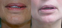 Bipolymer Removal (Silicone Injection Removal) Before and After - Pierini A Solution For Beauty