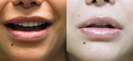 Bipolymer Removal (Silicone Injection Removal) Before and After - Pierini A Solution For Beauty