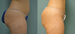 Brazilian Butt Lift Before and After - Pierini A Solution For Beauty