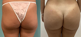 Brazilian Butt Lift Before and After - Pierini A Solution For Beauty