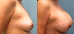 Breast Augmentation Before and After - Pierini A Solution For Beauty