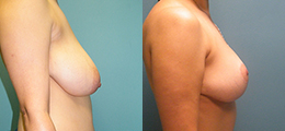 Breast Lift Before and After - Pierini A Solution For Beauty