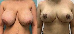 Breast Lift Before and After - Pierini A Solution For Beauty
