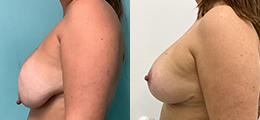 Breast Reduction Before and After - Pierini A Solution For Beauty