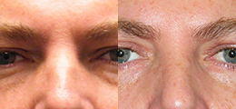 Eyelid Surgery Before and After - Pierini A Solution For Beauty