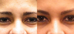 Eyelid Surgery Before and After - Pierini A Solution For Beauty