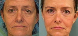 Facelift Before and After - Pierini A Solution For Beauty
