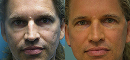 Facelift Before and After - Pierini A Solution For Beauty
