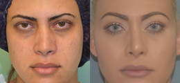 Facial Feminization Surgery Before and After - Pierini A Solution For Beauty