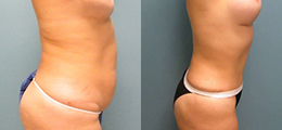 Fat Transfer Before and After - Pierini A Solution For Beauty