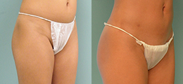 Fat Transfer Before and After - Pierini A Solution For Beauty