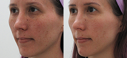 Fraxel® Laser Skin Treatment Before and After - Pierini A Solution For Beauty