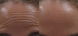 BOTOX® Cosmetic Before and After - Pierini A Solution For Beauty