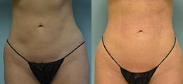 Renuvion®/J-Plasma Skin Tightening Before and After - Pierini A Solution For Beauty