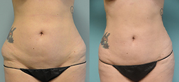 Liposuction Before and After - Pierini A Solution For Beauty
