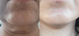 Neck Lift Before and After - Pierini A Solution For Beauty