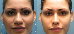 Rhinoplasty Before and After - Pierini A Solution For Beauty