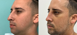Rhinoplasty Before and After - Pierini A Solution For Beauty