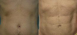 Six-Pack Abs Surgery (Liposculpture) Before and After - Pierini A Solution For Beauty