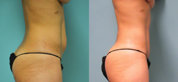 Tummy Tuck Before and After - Pierini A Solution For Beauty