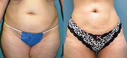 Tummy Tuck Before and After - Pierini A Solution For Beauty