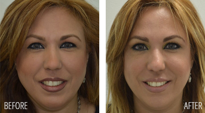 Botox Before and After Example