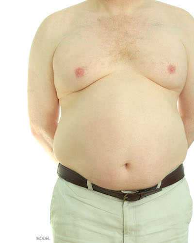 A heavy set man's torso with no shirt, showing the presence of male breasts