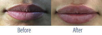 Restylane Before and After 2