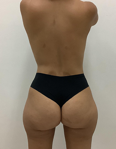 Brazilian Butt Lift After