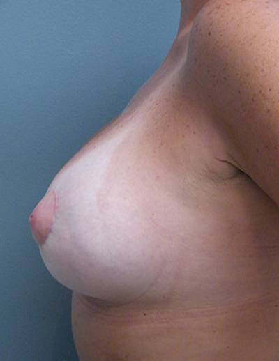 Breast Lift After
