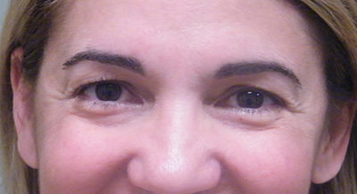 Brow Lift Before