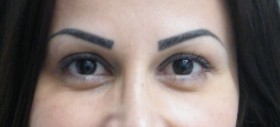 Brow Lift After