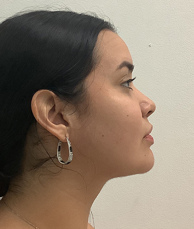 Double Chin (Submental Liposuction)  After