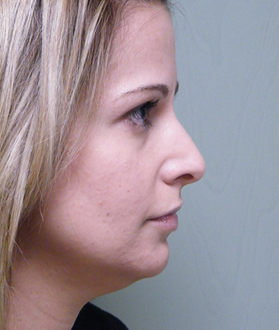 Double Chin (Submental Liposuction) Before