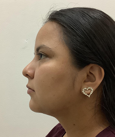 Chin Augmentation After